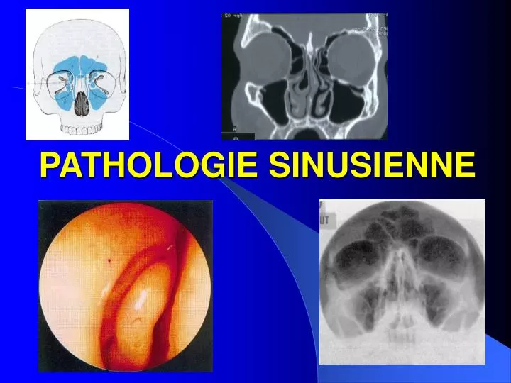 pathologie sinusienne