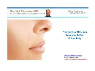 Non-Surgical Nose Job to rescue failed Rhinoplasty