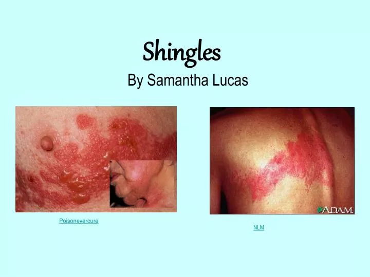 shingles