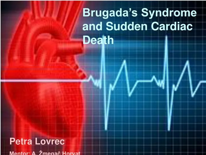 brugada s syndrome and sudden cardiac death