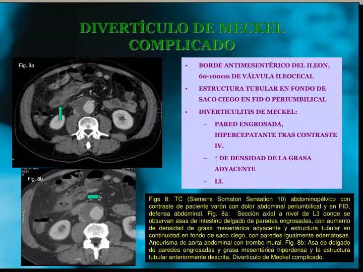 divert culo de meckel complicado