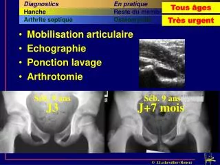 Mobilisation articulaire Echographie Ponction lavage Arthrotomie