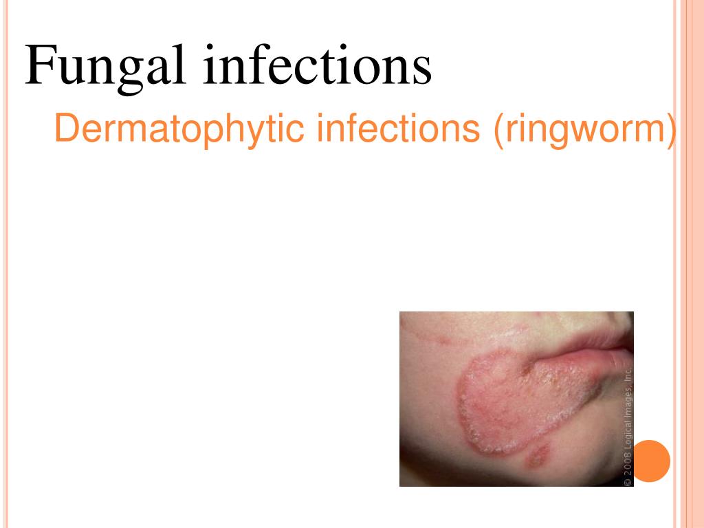 PPT - Fungal infections Dermatophytic infections (ringworm) PowerPoint ...