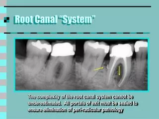 Root Canal “System”