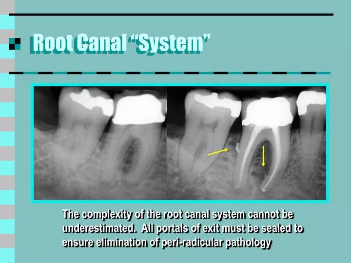 root canal system