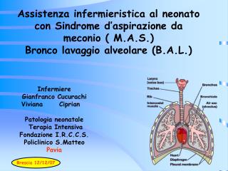 Assistenza infermieristica al neonato con Sindrome d’aspirazione da meconio ( M.A.S.) Bronco lavaggio alveolare (B.A.L.)