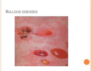 Bullous diseases