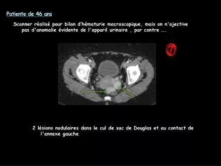 patiente de 46 ans