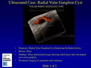 Ultrasound Case: Radial Volar Ganglion Cyst