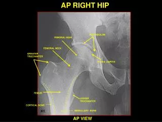 AP RIGHT HIP