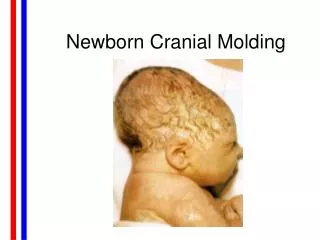 Newborn Cranial Molding