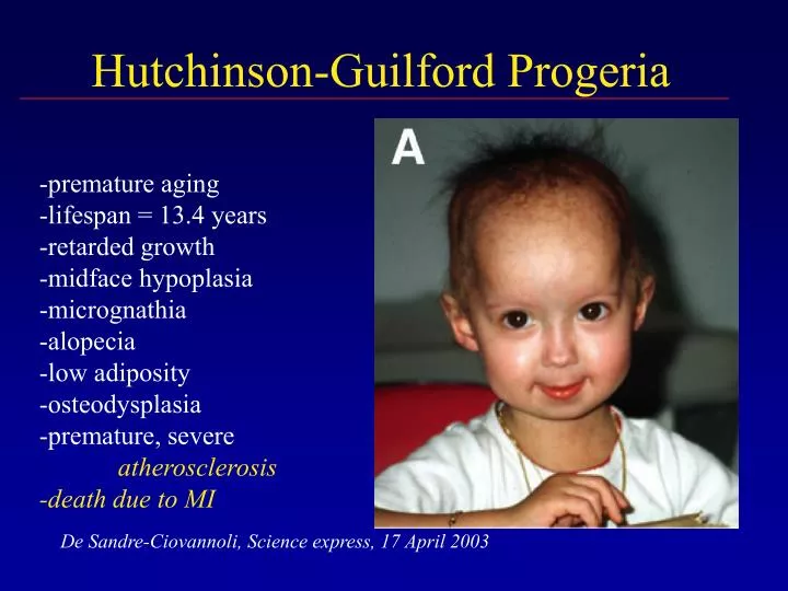 hutchinson guilford progeria