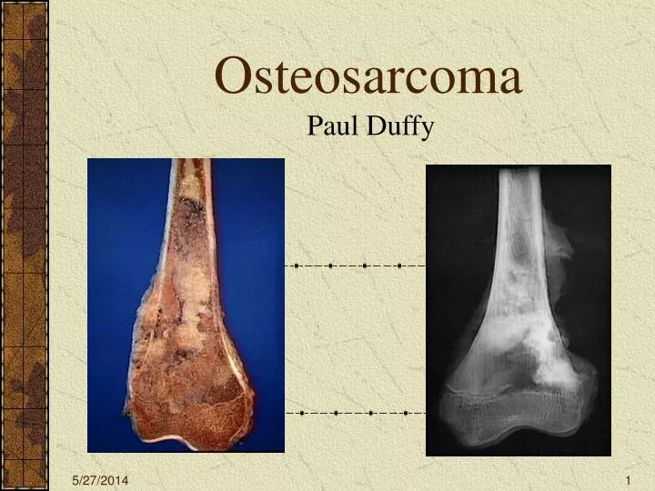 osteosarcoma