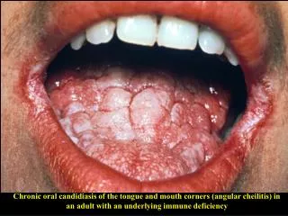 Chronic oral candidiasis of the tongue and mouth corners (angular cheilitis) in an adult with an underlying immune defic