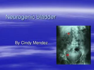 Neurogenic bladder