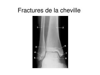 Fractures de la cheville