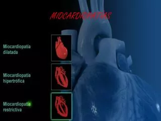 miocardiopat as