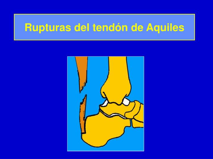 rupturas del tend n de aquiles