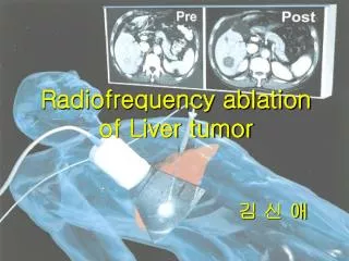 Radiofrequency ablation of Liver tumor