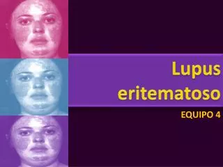 lupus eritematoso