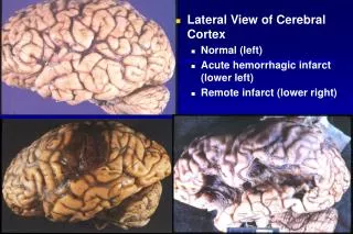 Lateral View of Cerebral Cortex Normal (left) Acute hemorrhagic infarct (lower left) Remote infarct (lower right)