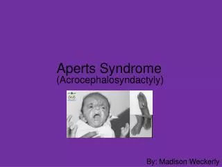 Aperts Syndrome