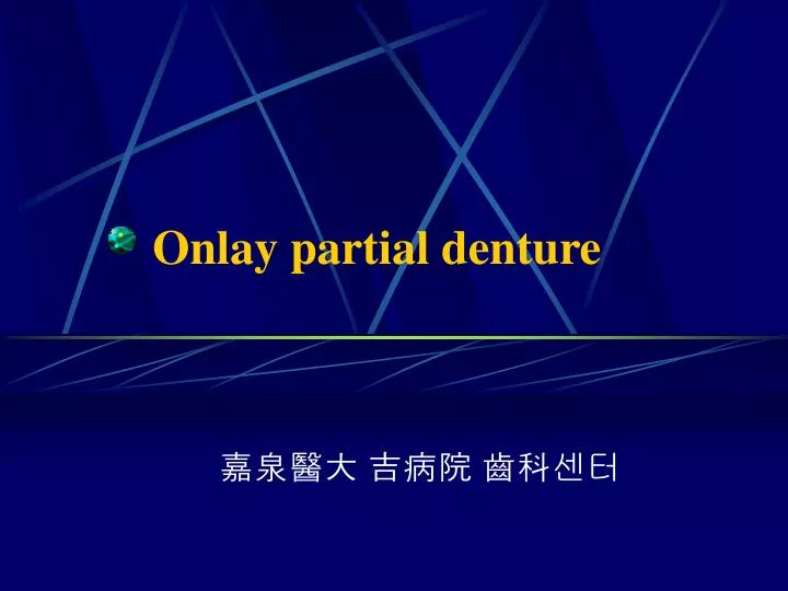 onlay partial denture