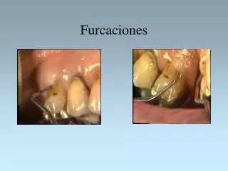 furcaciones