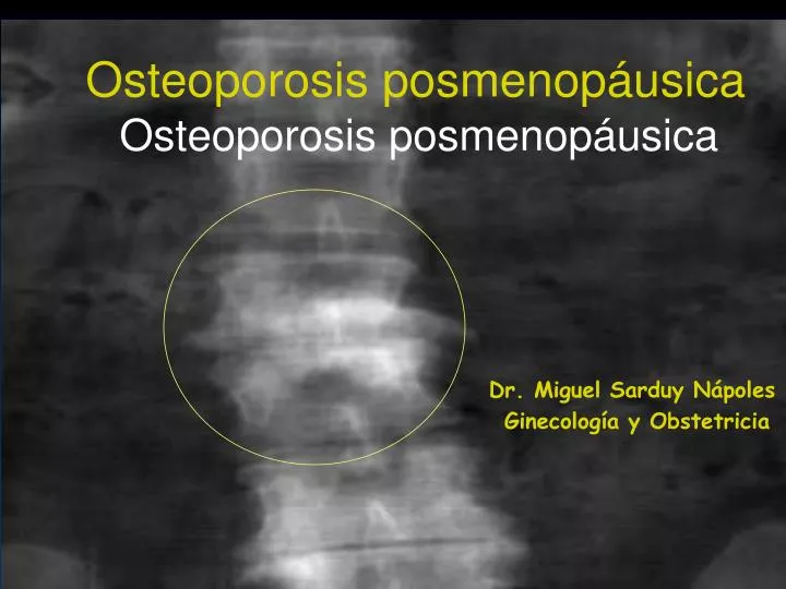osteoporosis posmenop usica