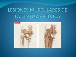 LESIONES MUSCULARES DE LA CINTURA PELVICA