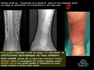 Patiente de 88 ans Traumatisme de la cheville G .Quel est votre diagnostic devant ces images de calcifications ( ou d