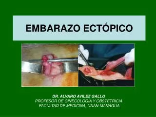 embarazo ect pico