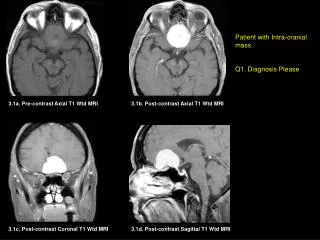 3.1a. Pre-contrast Axial T1 Wtd MRI