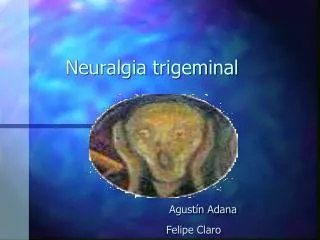 Neuralgia trigeminal