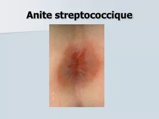 anite streptococcique
