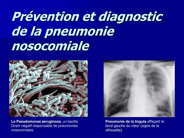 pr vention et diagnostic de la pneumonie nosocomiale