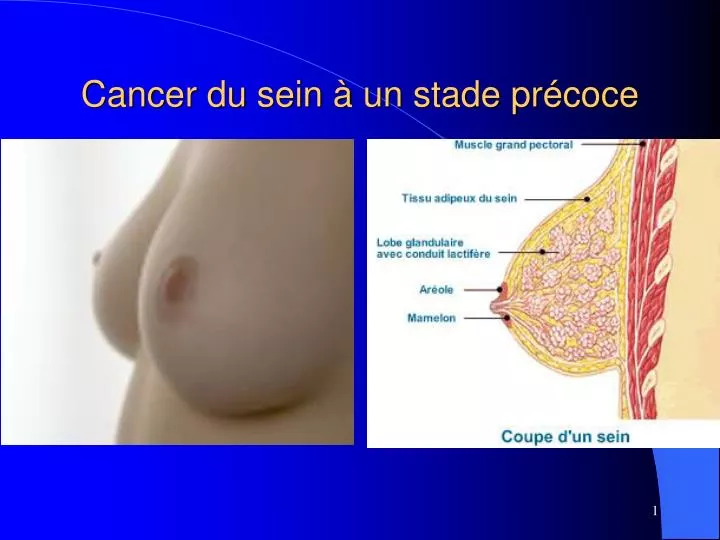 cancer du sein un stade pr coce