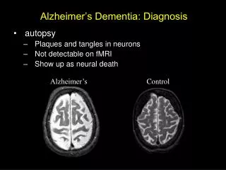 Alzheimer’s Dementia: Diagnosis