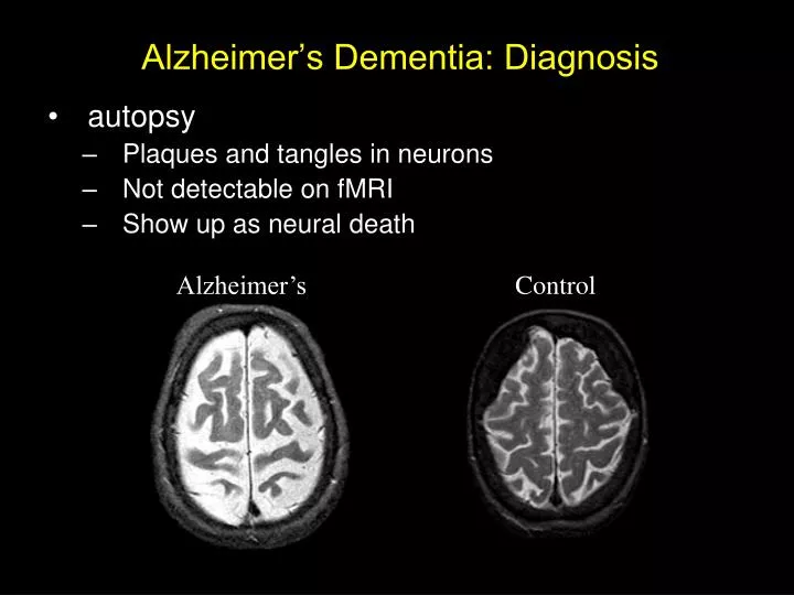 alzheimer s dementia diagnosis