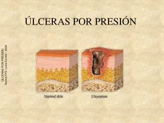 ÚLCERAS POR PRESIÓN