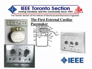 The First External Cardiac Pacemaker