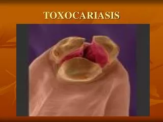 TOXOCARIASIS