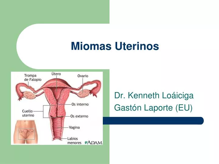 miomas uterinos