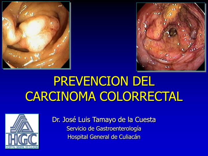 prevencion del carcinoma colorrectal