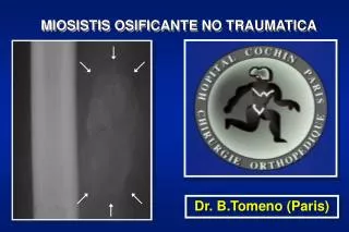 miosistis osificante no traumatica