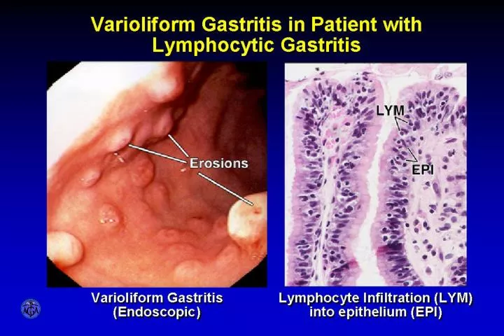 varioliform gastritis in patient with lymphocytic gastritis