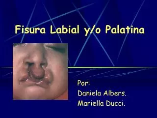 Fisura Labial y/o Palatina