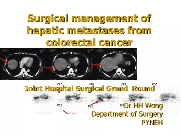 surgical management of hepatic metastases from colorectal cancer