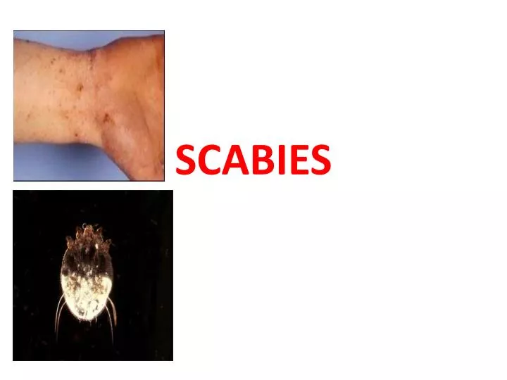 scabies